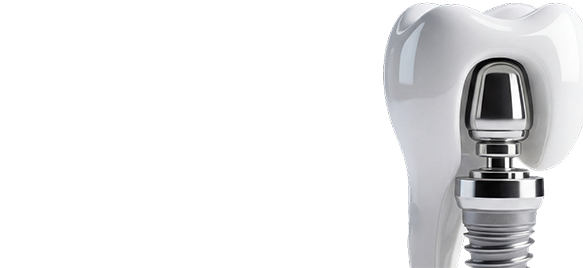 Имплантация