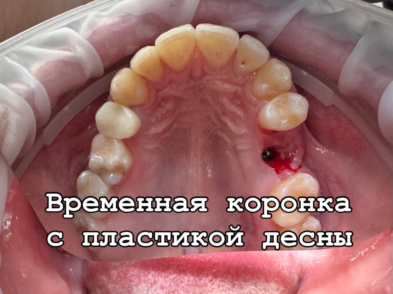 До — Временная коронка с пластикой десны
