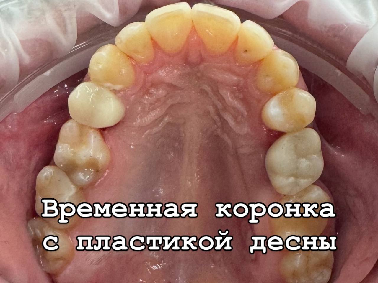 После — Временная коронка с пластикой десны